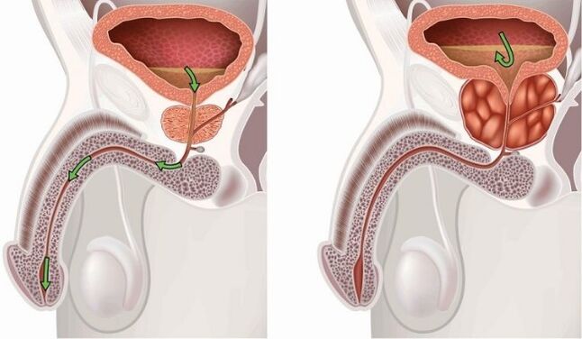 Healthy and sore prostate