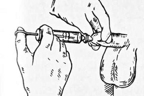 Prostatitis drip