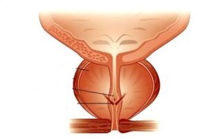 Prostatitis and its drug treatment